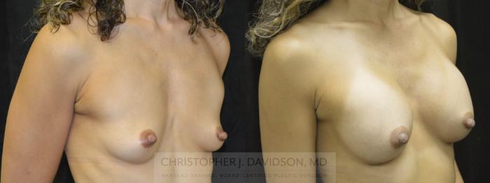 Breast Augmentation Case 12 Before & After View #3 | Boston, MA | Christopher J. Davidson, MD