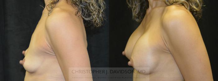Breast Augmentation Case 12 Before & After View #4 | Boston, MA | Christopher J. Davidson, MD