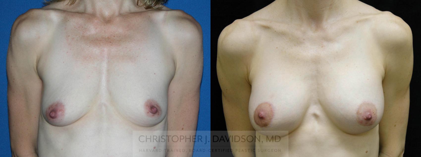 Breast Augmentation Case 121 Before & After View #1 | Boston, MA | Christopher J. Davidson, MD