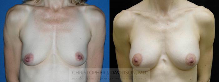 Breast Augmentation Case 121 Before & After View #1 | Boston, MA | Christopher J. Davidson, MD