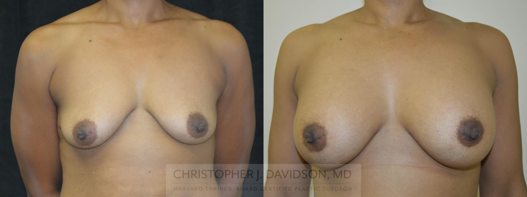 Breast Augmentation Case 123 Before & After View #1 | Wellesley, MA | Christopher J. Davidson, MD