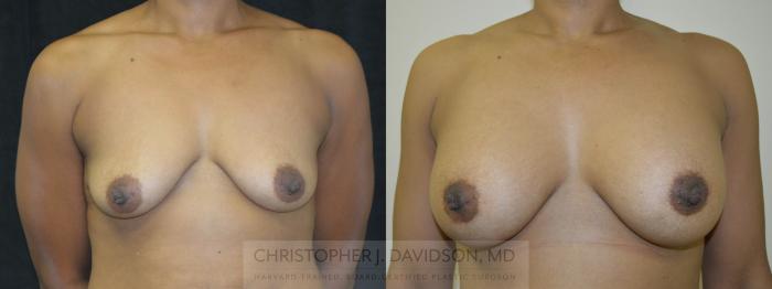 Breast Augmentation Case 123 Before & After View #1 | Boston, MA | Christopher J. Davidson, MD
