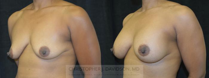 Breast Augmentation Case 123 Before & After View #3 | Boston, MA | Christopher J. Davidson, MD