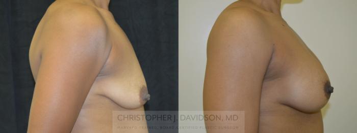 Breast Augmentation Case 123 Before & After View #4 | Boston, MA | Christopher J. Davidson, MD