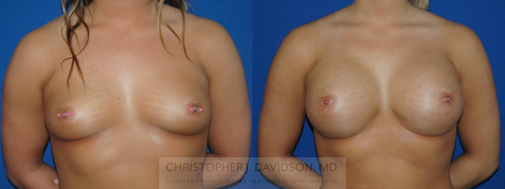 Breast Augmentation Case 128 Before & After View #1 | Boston, MA | Christopher J. Davidson, MD