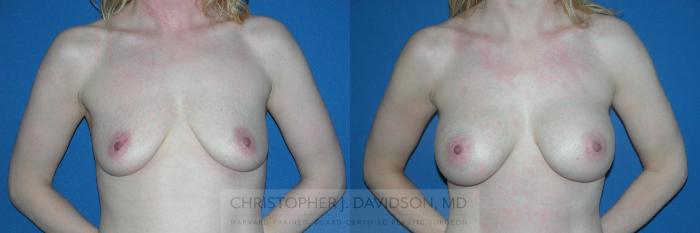 Breast Augmentation Case 131 Before & After View #1 | Boston, MA | Christopher J. Davidson, MD