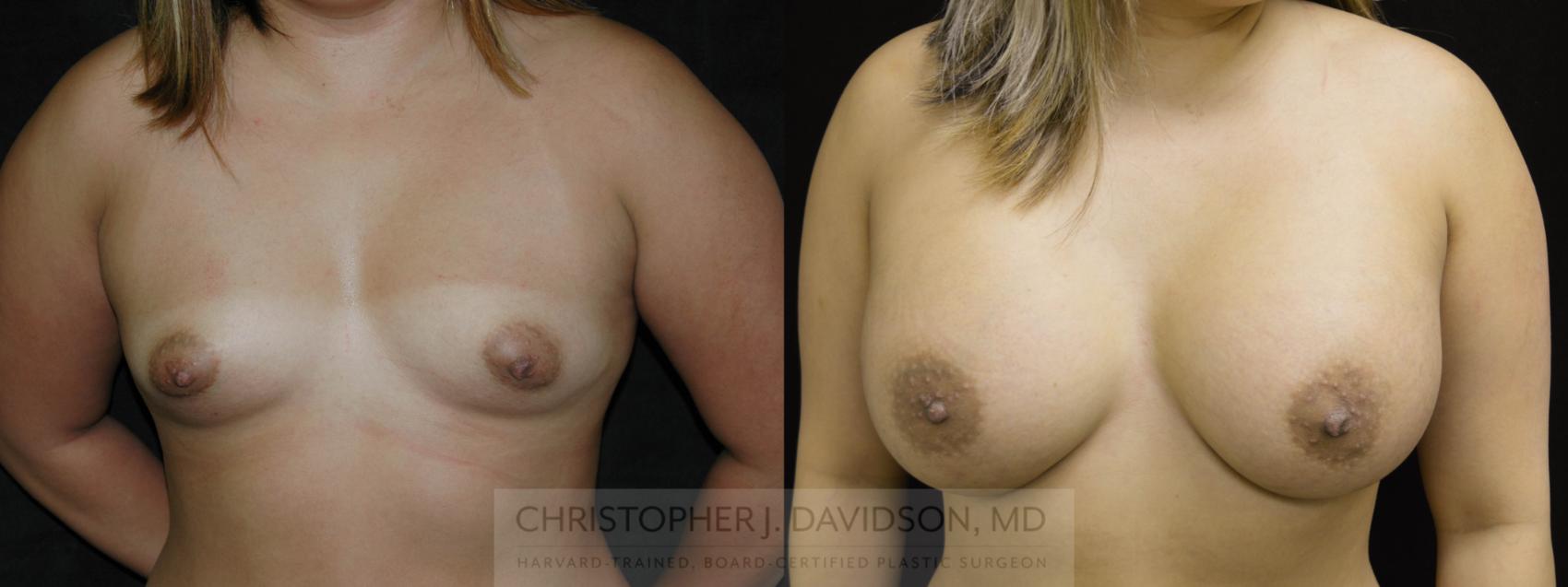Breast Augmentation Case 141 Before & After View #1 | Wellesley, MA | Christopher J. Davidson, MD
