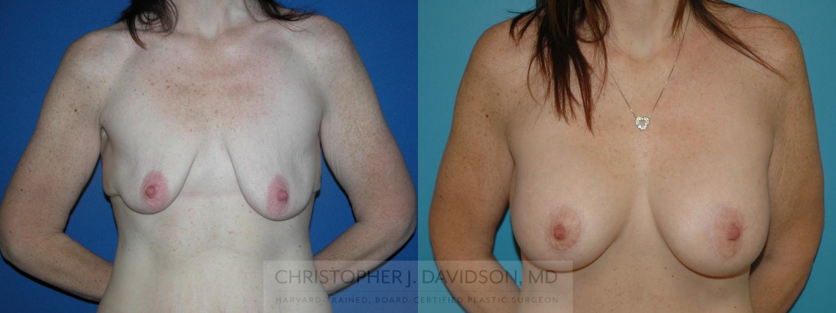 Breast Augmentation Case 148 Before & After View #1 | Wellesley, MA | Christopher J. Davidson, MD