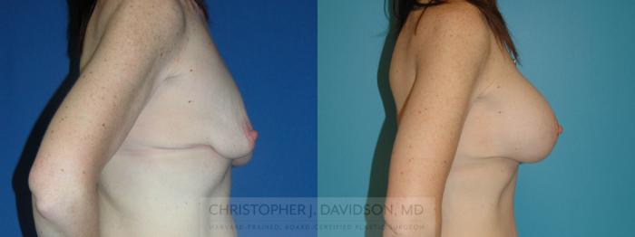 Breast Augmentation Case 148 Before & After View #2 | Boston, MA | Christopher J. Davidson, MD