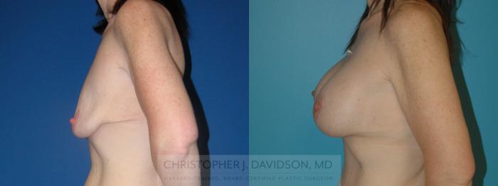 Breast Augmentation Case 148 Before & After View #3 | Boston, MA | Christopher J. Davidson, MD