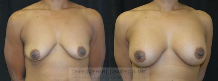 Breast Augmentation Case 16 Before & After View #1 | Boston, MA | Christopher J. Davidson, MD