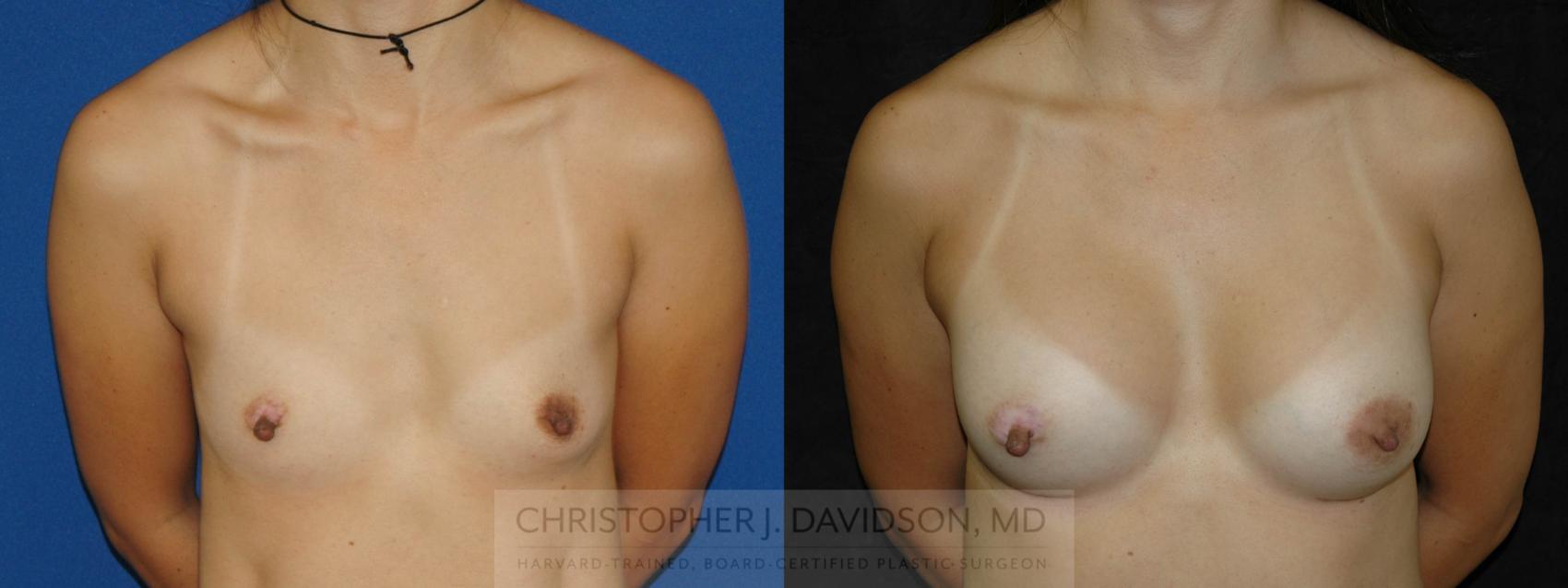 Breast Augmentation Case 163 Before & After View #1 | Boston, MA | Christopher J. Davidson, MD