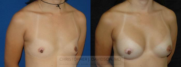 Breast Augmentation Case 163 Before & After View #2 | Boston, MA | Christopher J. Davidson, MD