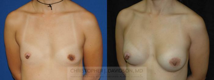 Breast Augmentation Case 163 Before & After View #3 | Boston, MA | Christopher J. Davidson, MD