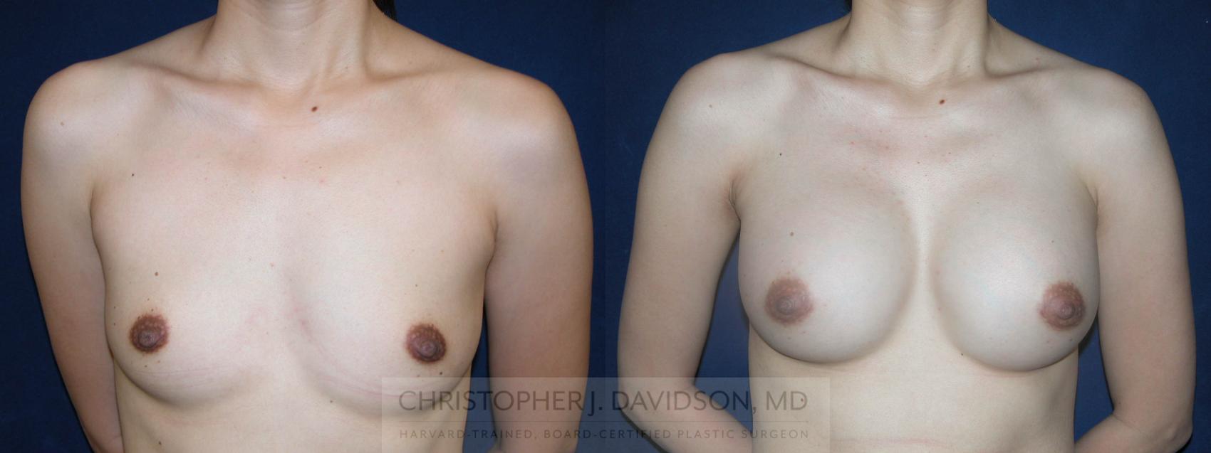 Breast Augmentation Case 166 Before & After View #1 | Wellesley, MA | Christopher J. Davidson, MD