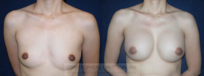 Breast Augmentation Case 166 Before & After View #1 | Boston, MA | Christopher J. Davidson, MD