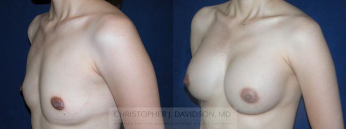 Breast Augmentation Case 166 Before & After View #3 | Boston, MA | Christopher J. Davidson, MD