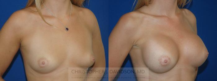 Breast Augmentation Case 167 Before & After View #2 | Boston, MA | Christopher J. Davidson, MD