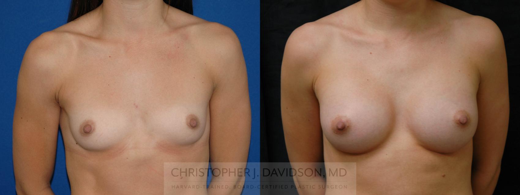 Breast Augmentation Case 168 Before & After View #1 | Boston, MA | Christopher J. Davidson, MD