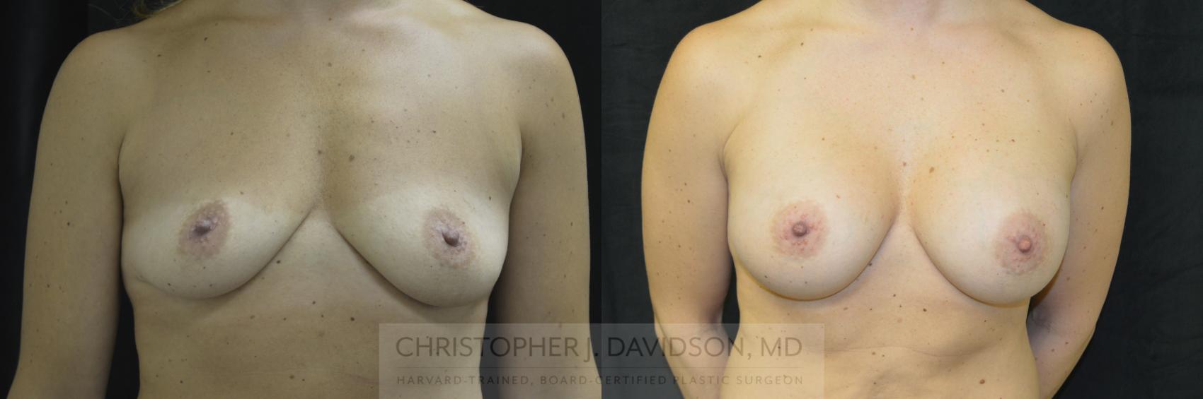 Breast Augmentation Case 172 Before & After View #1 | Boston, MA | Christopher J. Davidson, MD