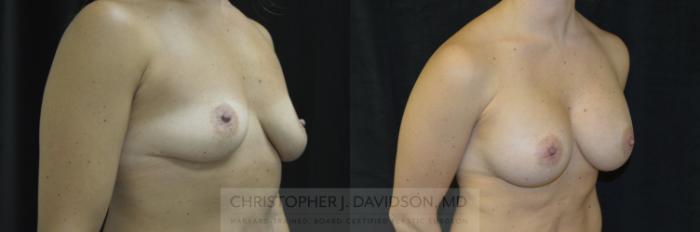 Breast Augmentation Case 172 Before & After View #2 | Boston, MA | Christopher J. Davidson, MD