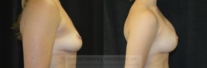 Breast Augmentation Case 172 Before & After View #3 | Boston, MA | Christopher J. Davidson, MD