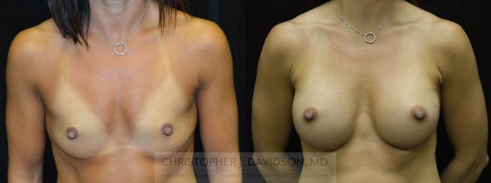 Breast Augmentation Case 178 Before & After View #1 | Boston, MA | Christopher J. Davidson, MD