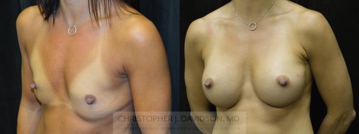 Breast Augmentation Case 178 Before & After View #3 | Boston, MA | Christopher J. Davidson, MD