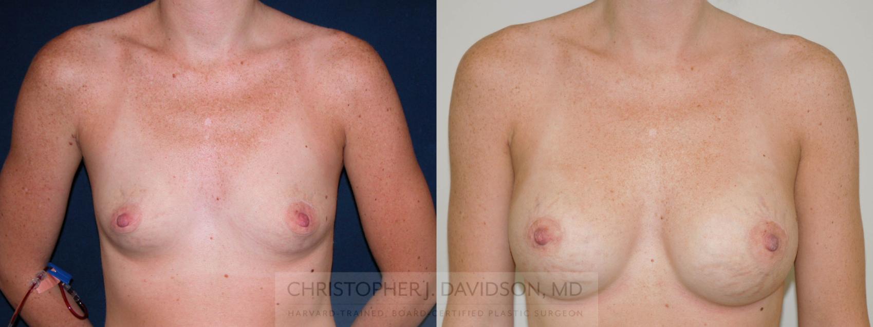 Breast Augmentation Case 179 Before & After View #1 | Boston, MA | Christopher J. Davidson, MD