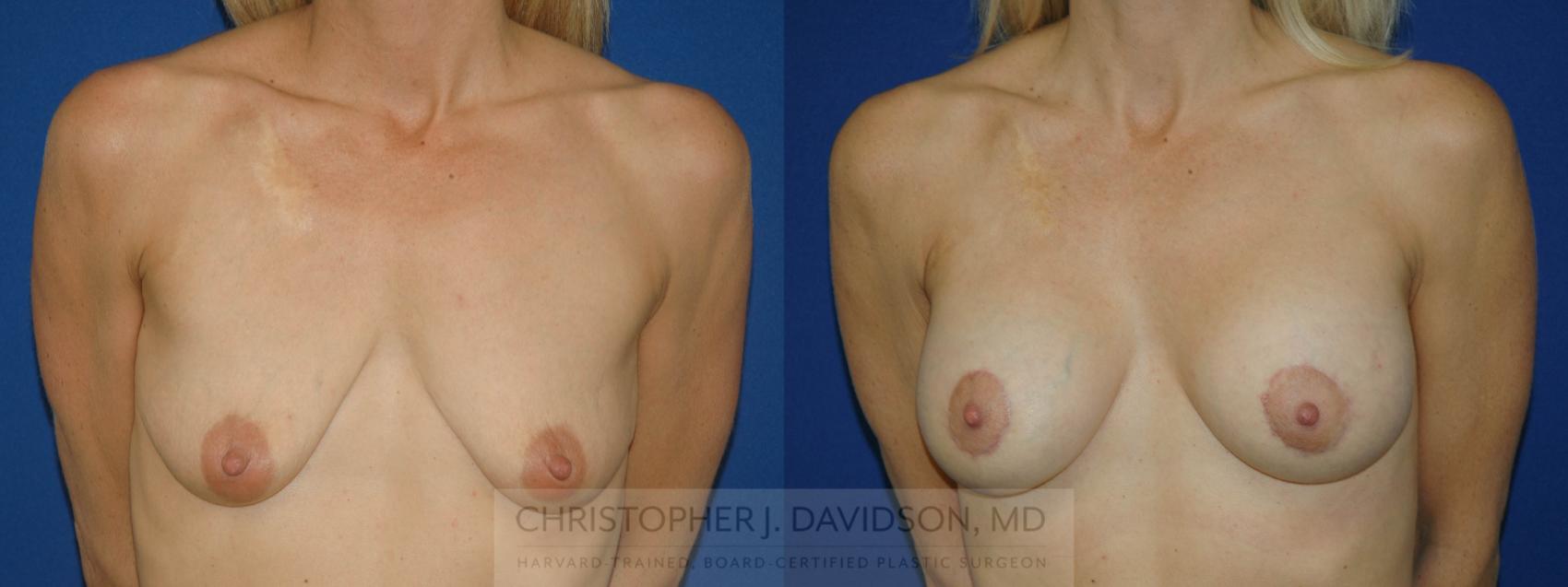 Breast Augmentation Case 180 Before & After View #1 | Boston, MA | Christopher J. Davidson, MD