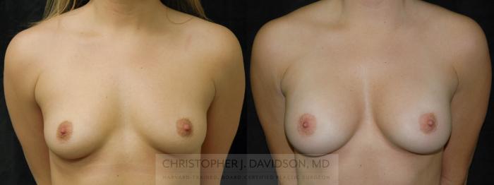 Breast Augmentation Case 190 Before & After View #1 | Boston, MA | Christopher J. Davidson, MD