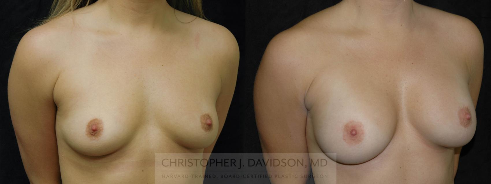 Breast Augmentation Case 190 Before & After View #2 | Wellesley, MA | Christopher J. Davidson, MD