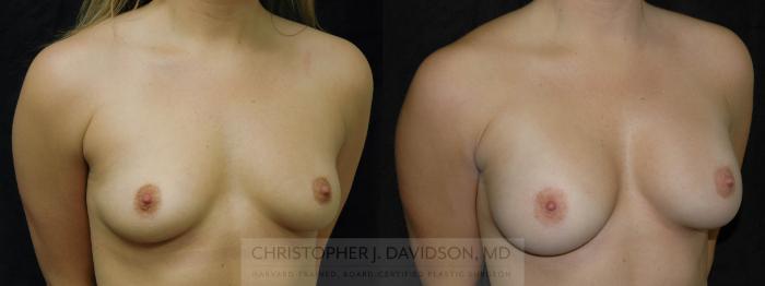 Breast Augmentation Case 190 Before & After View #2 | Boston, MA | Christopher J. Davidson, MD