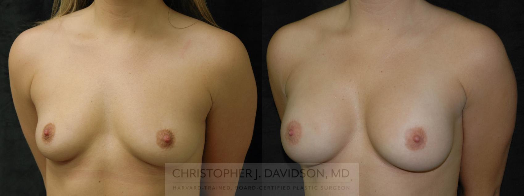 Breast Augmentation Case 190 Before & After View #3 | Wellesley, MA | Christopher J. Davidson, MD