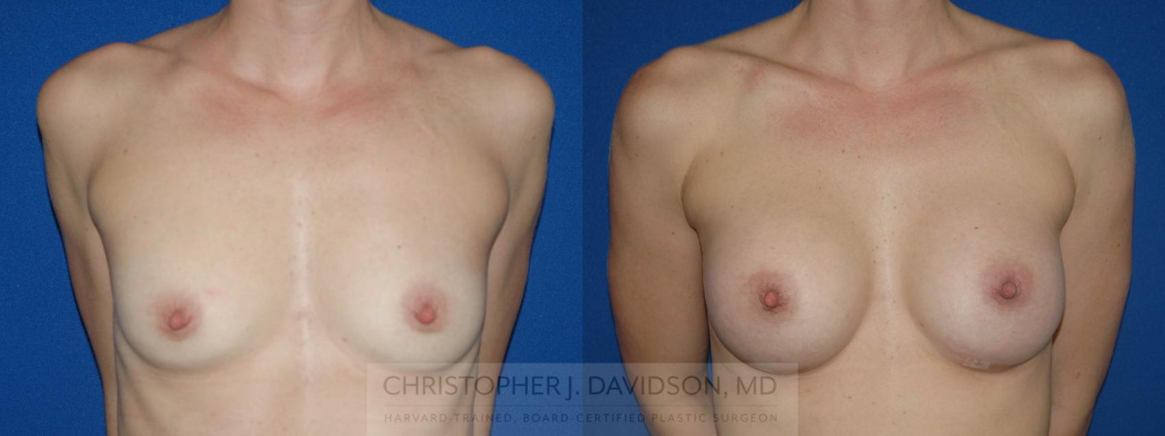 Breast Augmentation Case 199 Before & After View #1 | Wellesley, MA | Christopher J. Davidson, MD