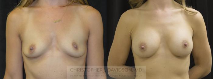 Breast Augmentation Case 20 Before & After View #1 | Boston, MA | Christopher J. Davidson, MD
