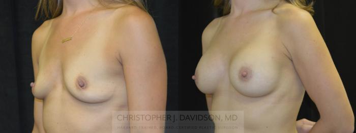 Breast Augmentation Case 20 Before & After View #3 | Boston, MA | Christopher J. Davidson, MD