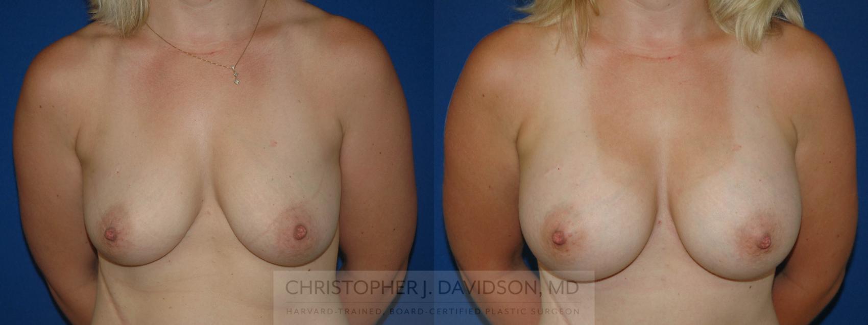 Breast Augmentation Case 209 Before & After View #1 | Boston, MA | Christopher J. Davidson, MD