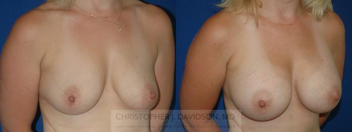 Breast Augmentation Case 209 Before & After View #2 | Boston, MA | Christopher J. Davidson, MD
