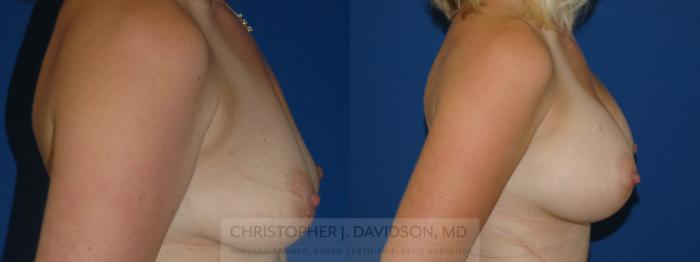 Breast Augmentation Case 209 Before & After View #3 | Boston, MA | Christopher J. Davidson, MD
