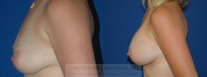 Breast Augmentation Case 209 Before & After View #4 | Boston, MA | Christopher J. Davidson, MD