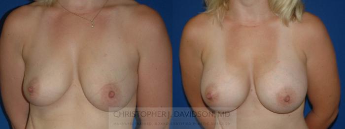 Breast Augmentation Case 209 Before & After View #5 | Boston, MA | Christopher J. Davidson, MD