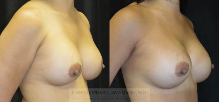 Breast Augmentation Case 21 Before & After View #3 | Boston, MA | Christopher J. Davidson, MD