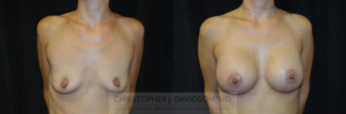 Breast Augmentation Case 220 Before & After View #1 | Boston, MA | Christopher J. Davidson, MD