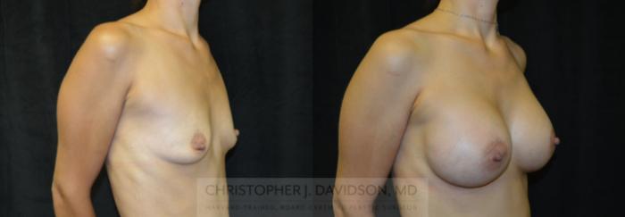 Breast Augmentation Case 220 Before & After View #2 | Boston, MA | Christopher J. Davidson, MD