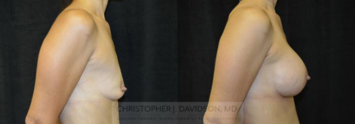 Breast Augmentation Case 220 Before & After View #3 | Boston, MA | Christopher J. Davidson, MD