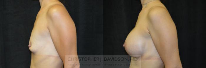 Breast Augmentation Case 220 Before & After View #4 | Boston, MA | Christopher J. Davidson, MD