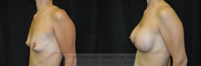 Breast Augmentation Case 220 Before & After View #5 | Boston, MA | Christopher J. Davidson, MD