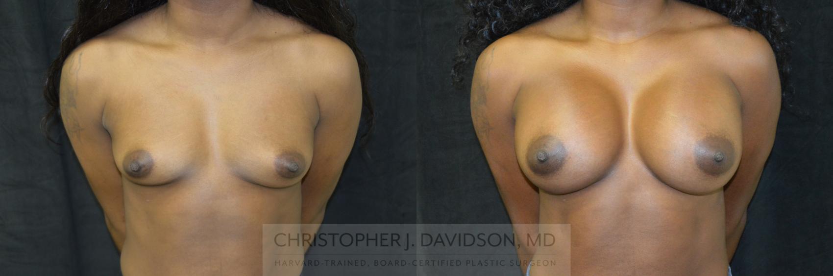 Breast Augmentation Case 221 Before & After View #1 | Wellesley, MA | Christopher J. Davidson, MD