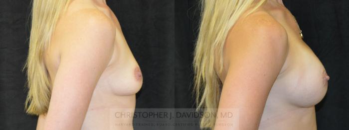 Breast Augmentation Case 222 Before & After View #3 | Boston, MA | Christopher J. Davidson, MD